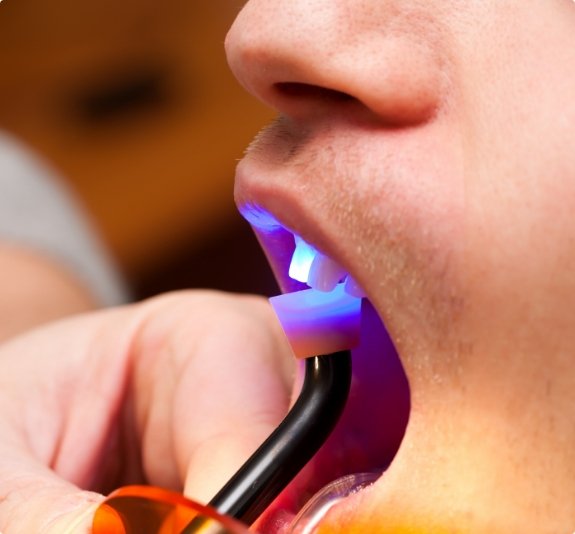 Close up of dental patient getting direct bonding on upper tooth