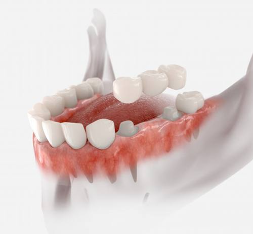 Illustration of dental bridge supported by crowns