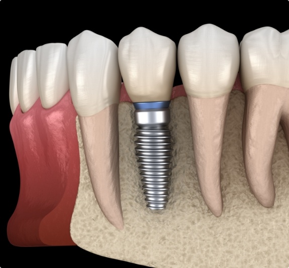 Illustrated dental implant replacing a missing lower tooth