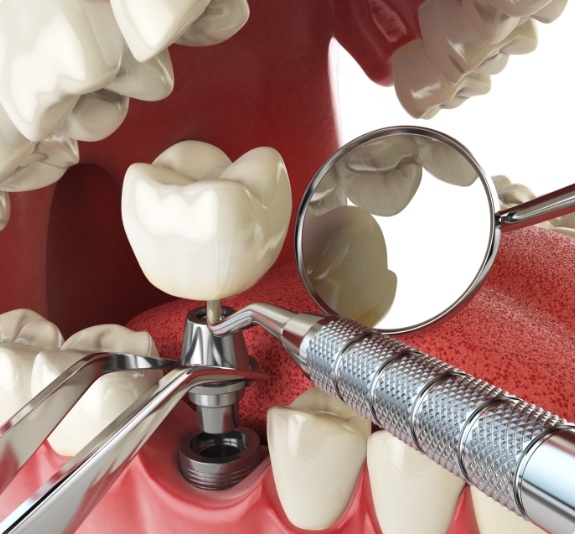 Illustrated dental implant being placed in the lower jaw