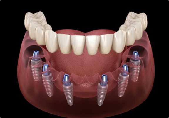 Illustrated denture being placed onto six dental implants