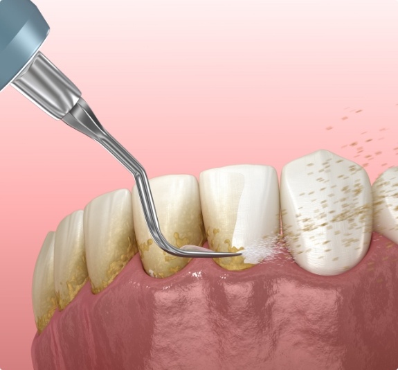 Illustrated dental instrument clearing plaque from teeth