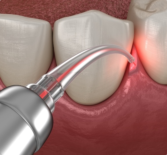 Illustrated dental laser treating gum disease