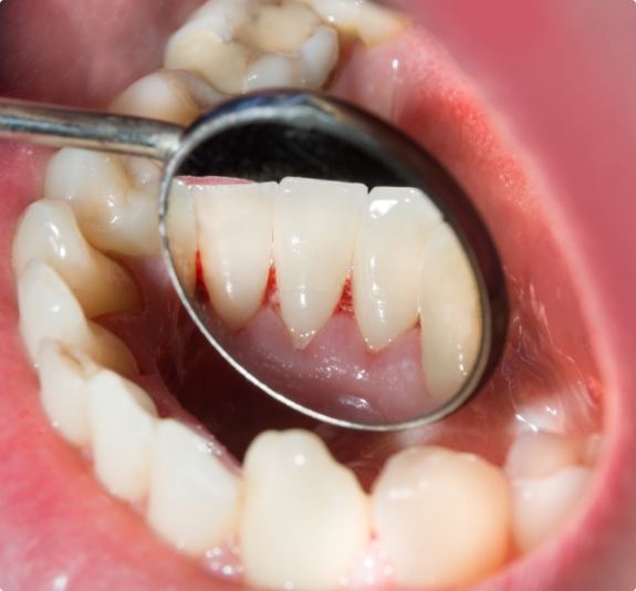 Close up of dental mirror inside of mouth