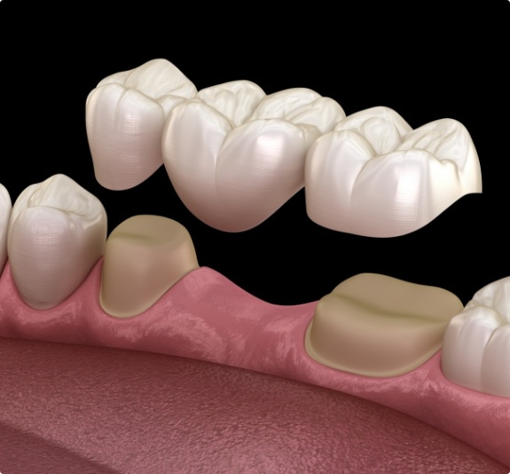 Illustrated dental bridge replacing a missing tooth