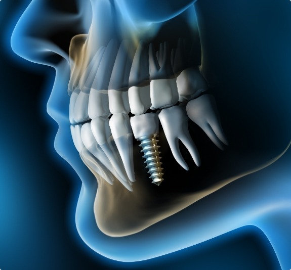 Illustrated side profile of person with dental implant replacing a tooth