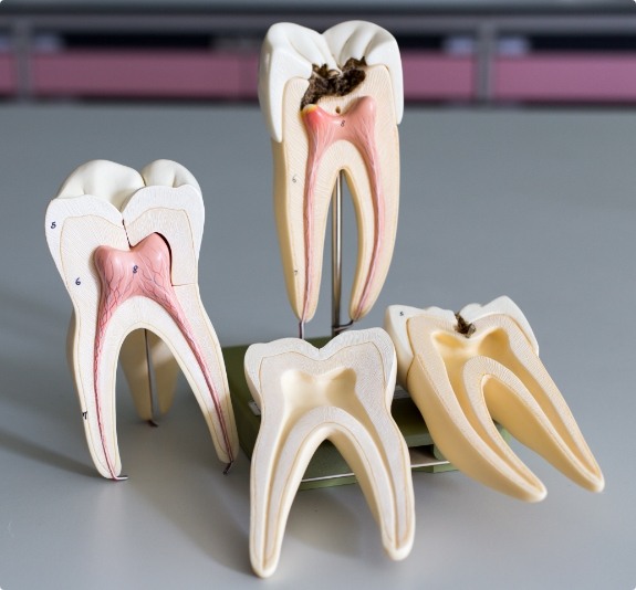 Models of damaged teeth needing root canal treatment