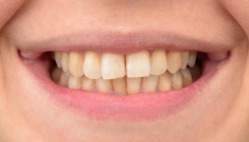 Close up of imperfect teeth before dental treatment