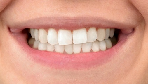 Close up of flawless teeth after dental treatment