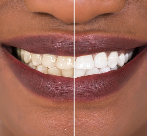 Patient's smile before and after teeth whitening treatment